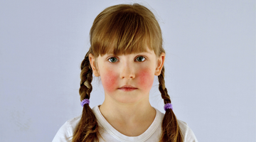 Face Skin Problems Among kids