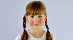 Face Skin Problems Among kids 