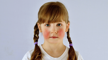 Face Skin Problems Among kids 